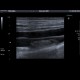 Thrombosis of femoral vein, subacute: US - Ultrasound